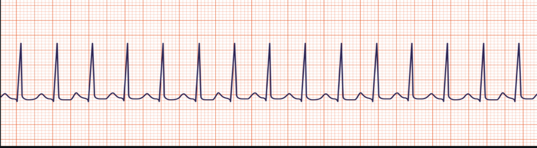 <p>ECG intrepretation</p>