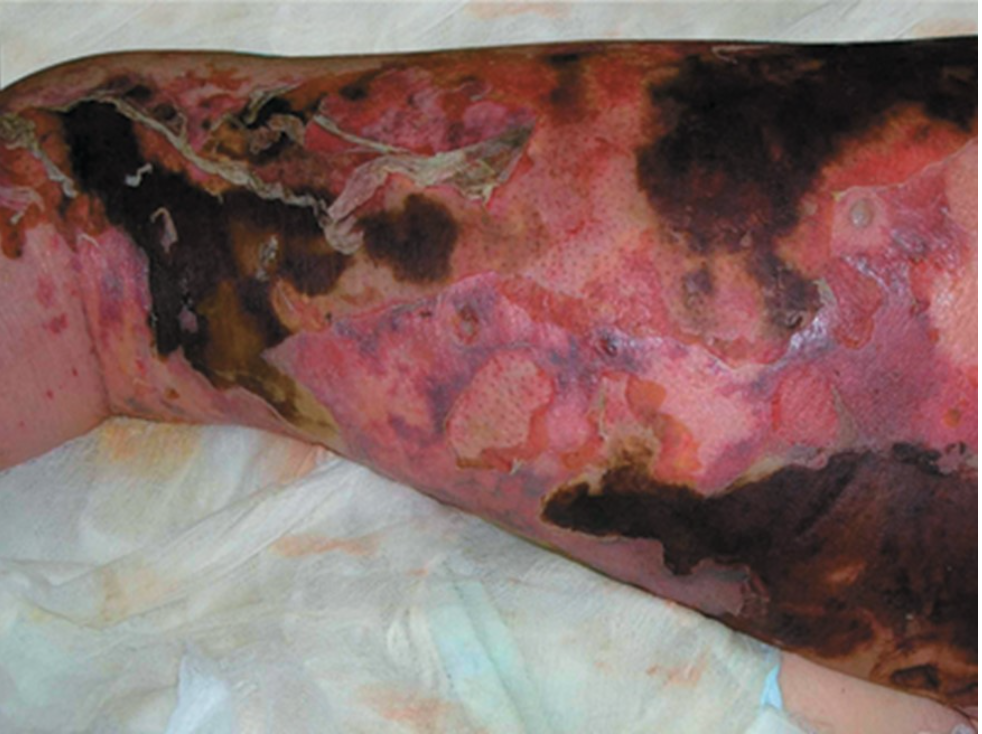 <p>what is the name of the infection caused by<em> Streptococcus pyogenes</em>&nbsp;that is depicted in the image?</p>