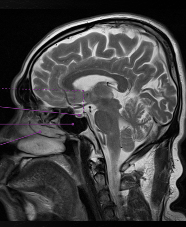 <p>Sphenoid</p>