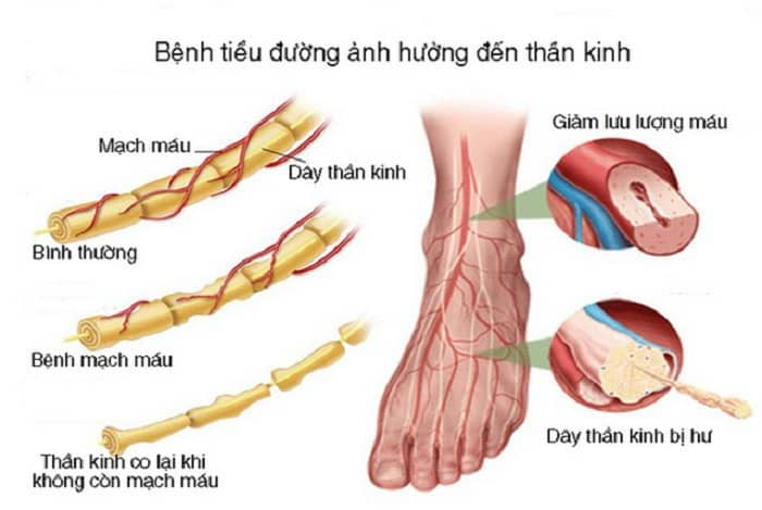<p>bệnh thần kinh (ngoại biên) do đái tháo đường</p>