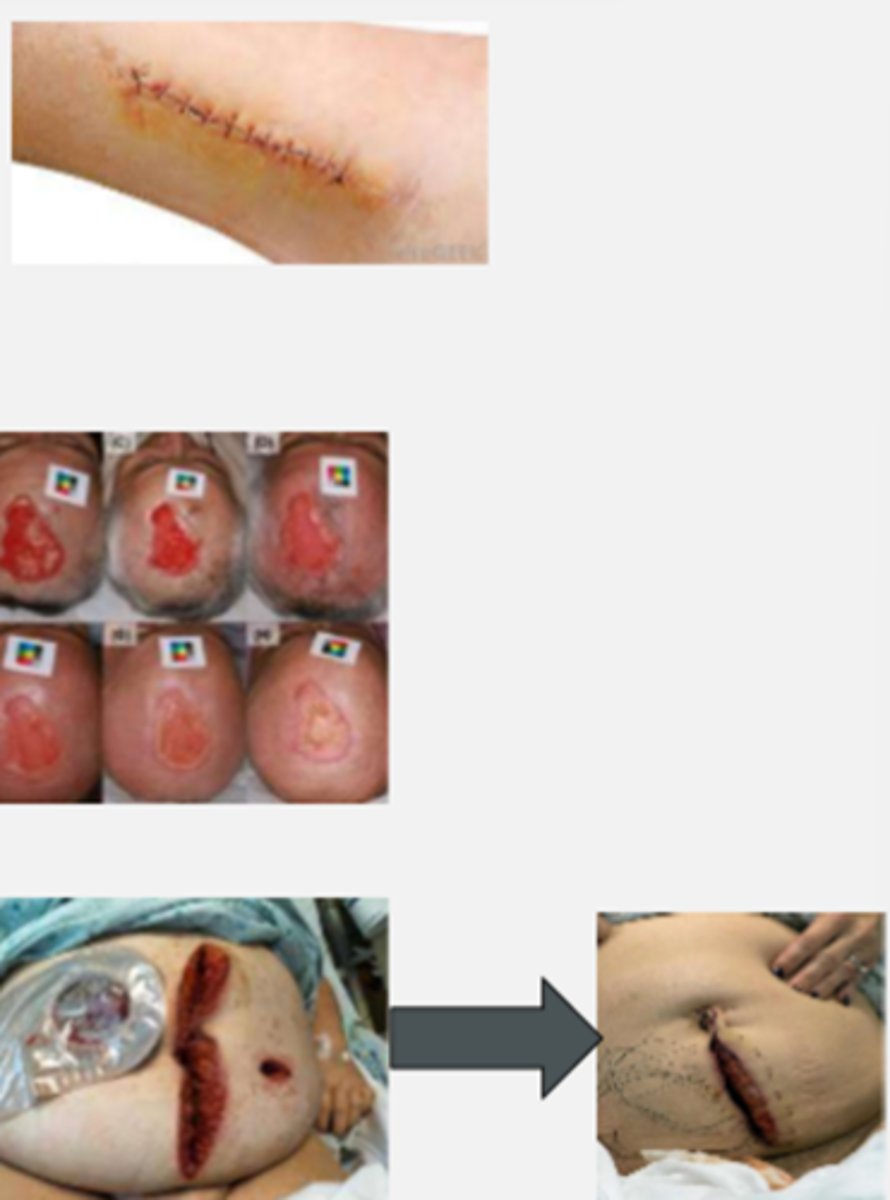 <p>PRIMARY INTENTION</p><p>- surgical wound closure</p><p>(stitches, staples, etc.)</p><p>SECONDARY INTENTION</p><p>- wound edges can't approx. initially</p><p>(heals by granulation)</p><p>- natural healing process</p><p>(wound "fills in")</p><p>TERTIARY INTENTION</p><p>(delayed primary)</p><p>- intentionally leaving the wound open to start healing</p>