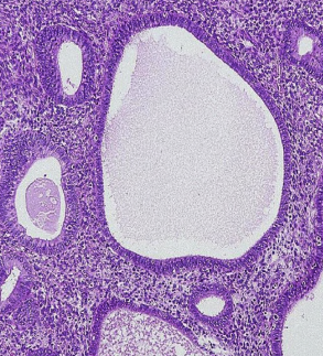 ### Hyperplasia - *Endometrial*