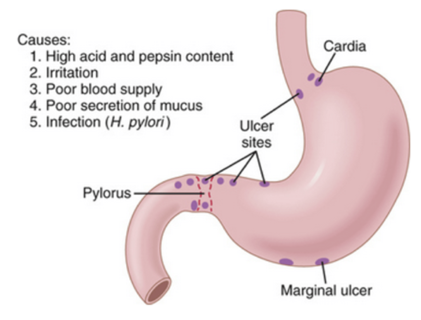 <p>open sores created on the digestive system epithelium, due to inadequate mucus protection --> acid corrosion</p><p>1. duodenal</p><p>2. gastric= antrum of stomach</p>