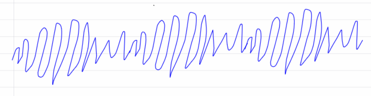 <p>what is this rythm and what med will you give during the code?</p>