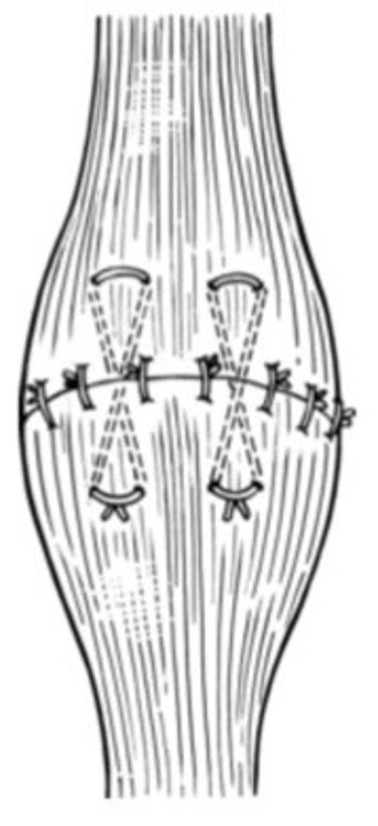 <p>If muscle is lacerated, how do we fix it?</p><p>Post-op care?</p>