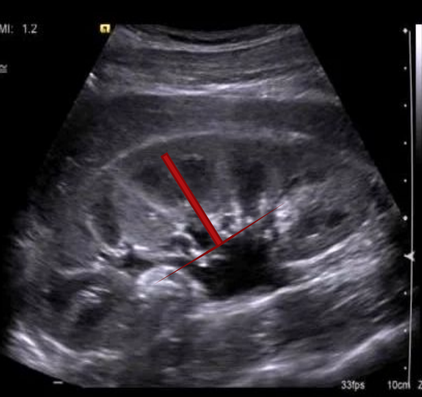 <ul><li><p>Indentation near the center of concave medial border of the kidney where the following structures enter and leave:</p><ul><li><p>Blood vessels </p><ul><li><p>Arteries enter</p></li><li><p>Veins leave</p></li></ul></li><li><p>Lymphatic vessels (take fluid out of kidney)</p></li><li><p>Ureter (exit)</p></li><li><p>Nerves (PSNS and SNS can regulate)</p></li></ul></li></ul><p></p>