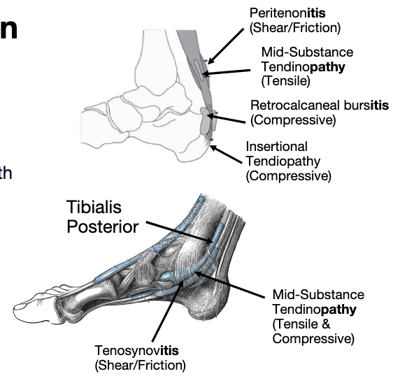 <ul><li><p>midportion of achilles </p></li><li><p>where tendon stores and release energy </p></li><li><p>CPG </p></li><li><p>where we exceed the capacity of the tendon is where we have injury</p></li><li><p><strong>Tensile or mid-substance pain will increase as the load increases<br>(double leg heel raise &lt; single leg heel raise &lt; double leg hop &lt;<br>Single leg hop) </strong></p></li></ul><p></p>