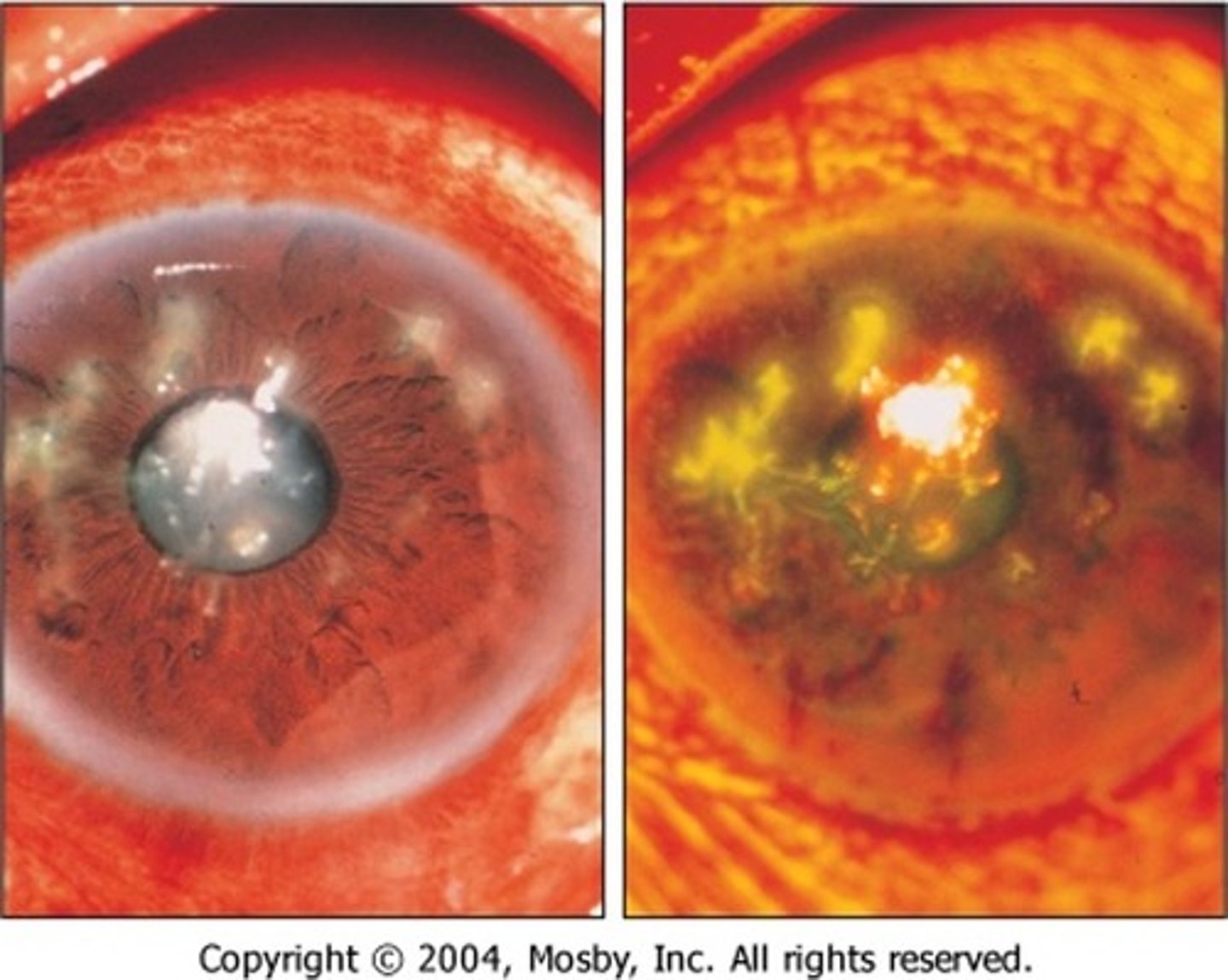 <p>disruption of the corneal epithelium and stroma</p><p>- probably take several days to develop</p>