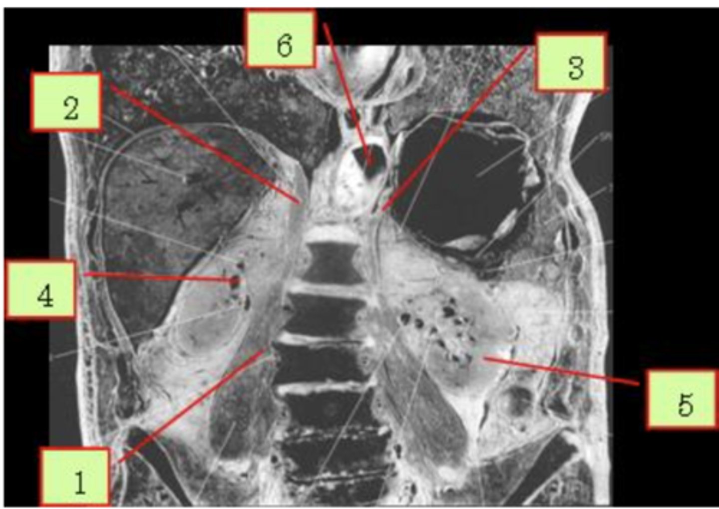 <p>the right kidney</p>