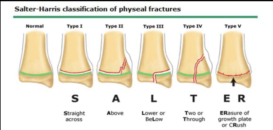 <p>Salter-Harris Fracture Classification</p>