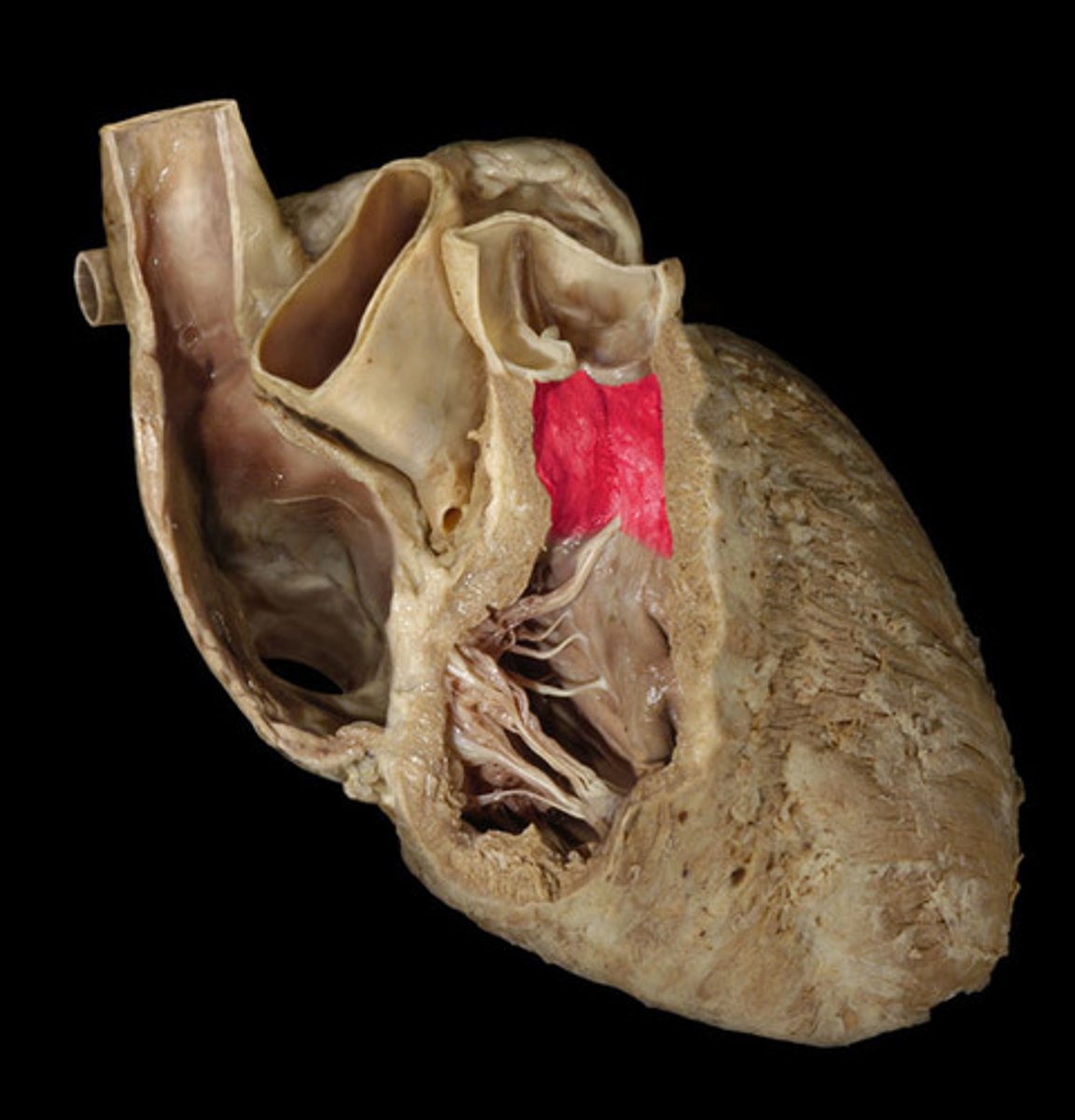 <p>the upper smooth-walled portion of the right ventricle, which leads to the pulmonary trunk</p>