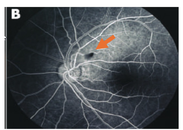 <p>hypofluorescence (blockage) due to CWS itself with adjacent hypofluorescence (filling defect) due to non-perfusion</p>