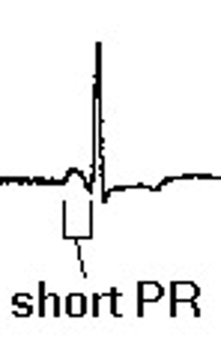 <p>AV node by passed, so short PRI</p><p>P adjacent to QRS</p>