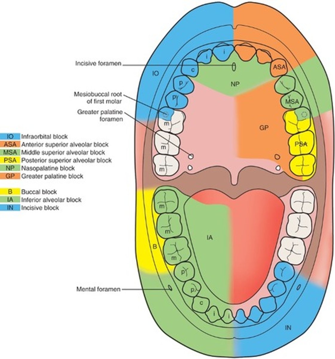 <p>Middle superior alveolar block</p><p>anesthetizes the pre-molars on one side and buccal side of the mesial cusp of the first molar</p>