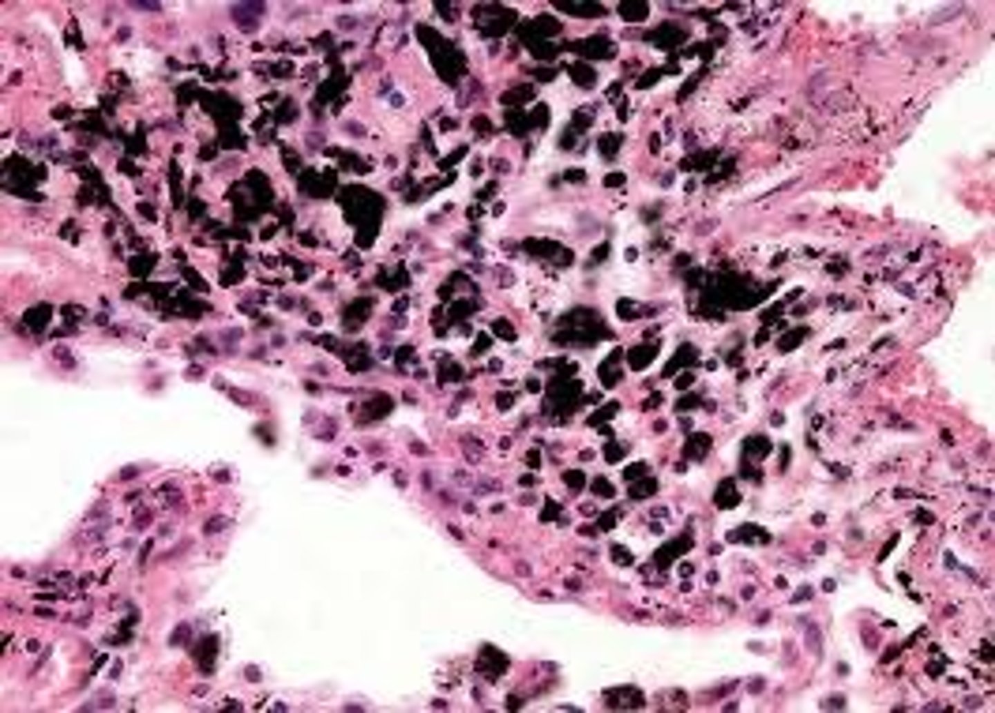 <p>Inflammed, narrowed airways, destroyed alveolar walls.</p><p>High airways resistance, and high alveolar compliance</p>