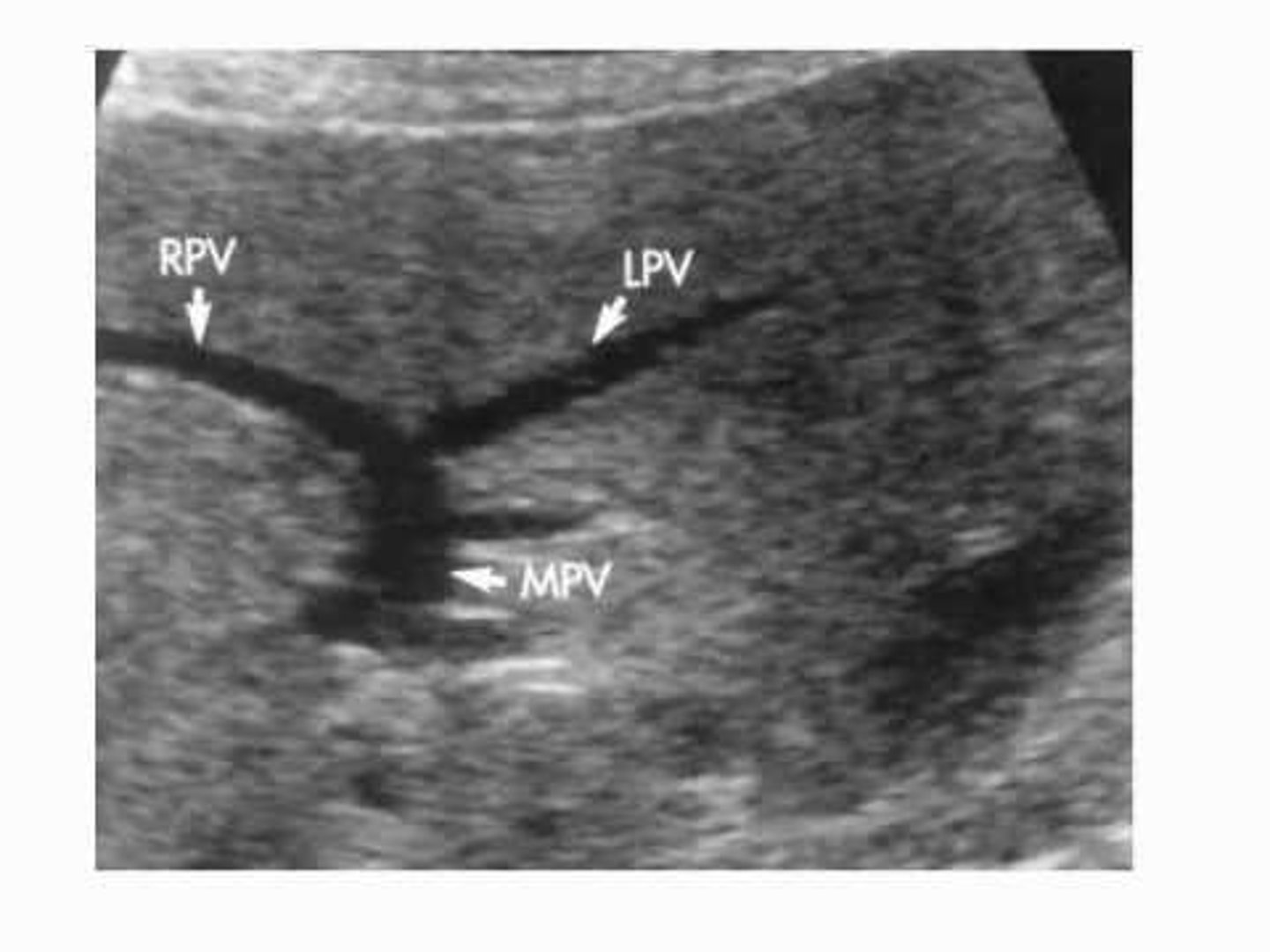 <p>It becomes larger at the portal hepatis and divides into the right and left portal veins.</p>