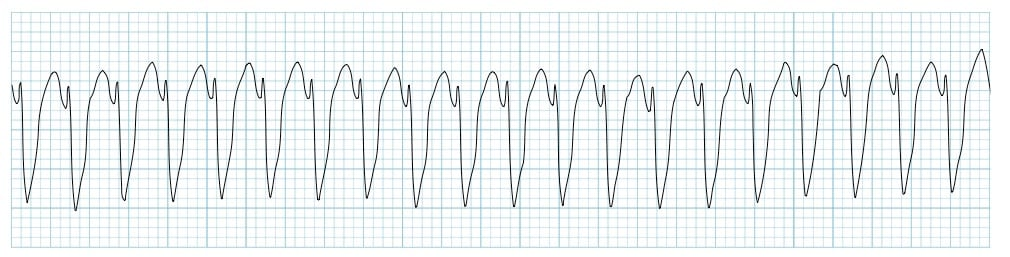 <ul><li><p>regular fast rhythm</p></li><li><p>large, irregular QRS complexes</p></li><li><p>P waves are either absent or random</p></li></ul><p></p>