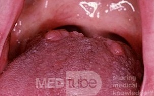 <p>circumvallate papillae</p>
