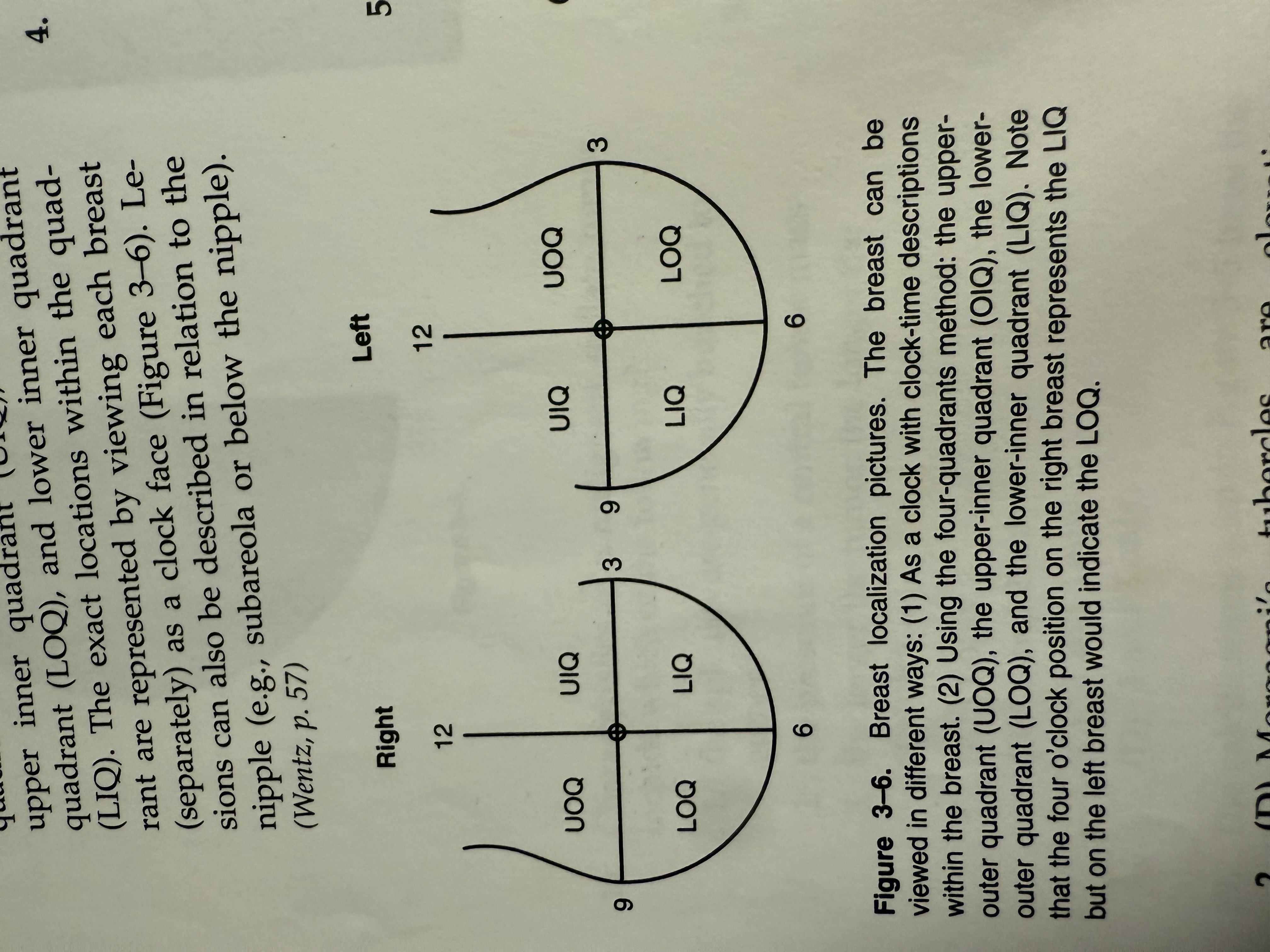 <p>(C) Each breast can be divided into four quadrants: the upper outer quadrant (UOQ), upper inner quadrant (UIQ), lower outer quadrant (LOQ), and lower inner quadrant</p><p>(LIQ). The exact locations within the quadrant are represented by viewing each breast (separately) as a clock face (Figure 3-6). Lesions can also be described in relation to the nipple (e.g., subareola or below the nipple).</p><p>(Wentz, p. 57)</p>