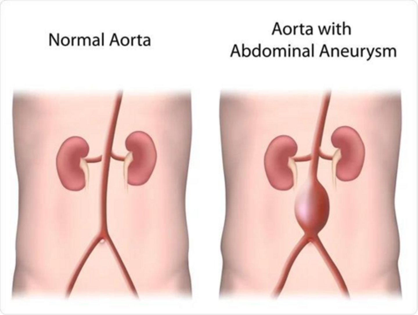 <p>Abdominal aortic aneurysm due to atherosclerotic changes.</p>