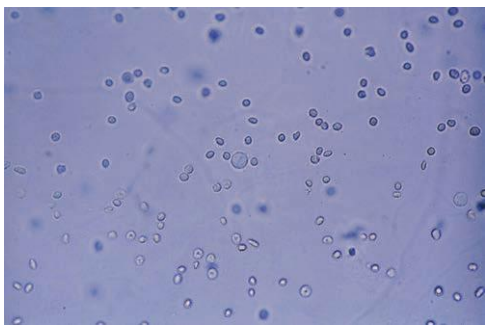 <p><span style="font-family: MyriadPro-Light;">Microcytic and crenated RBCs</span></p>