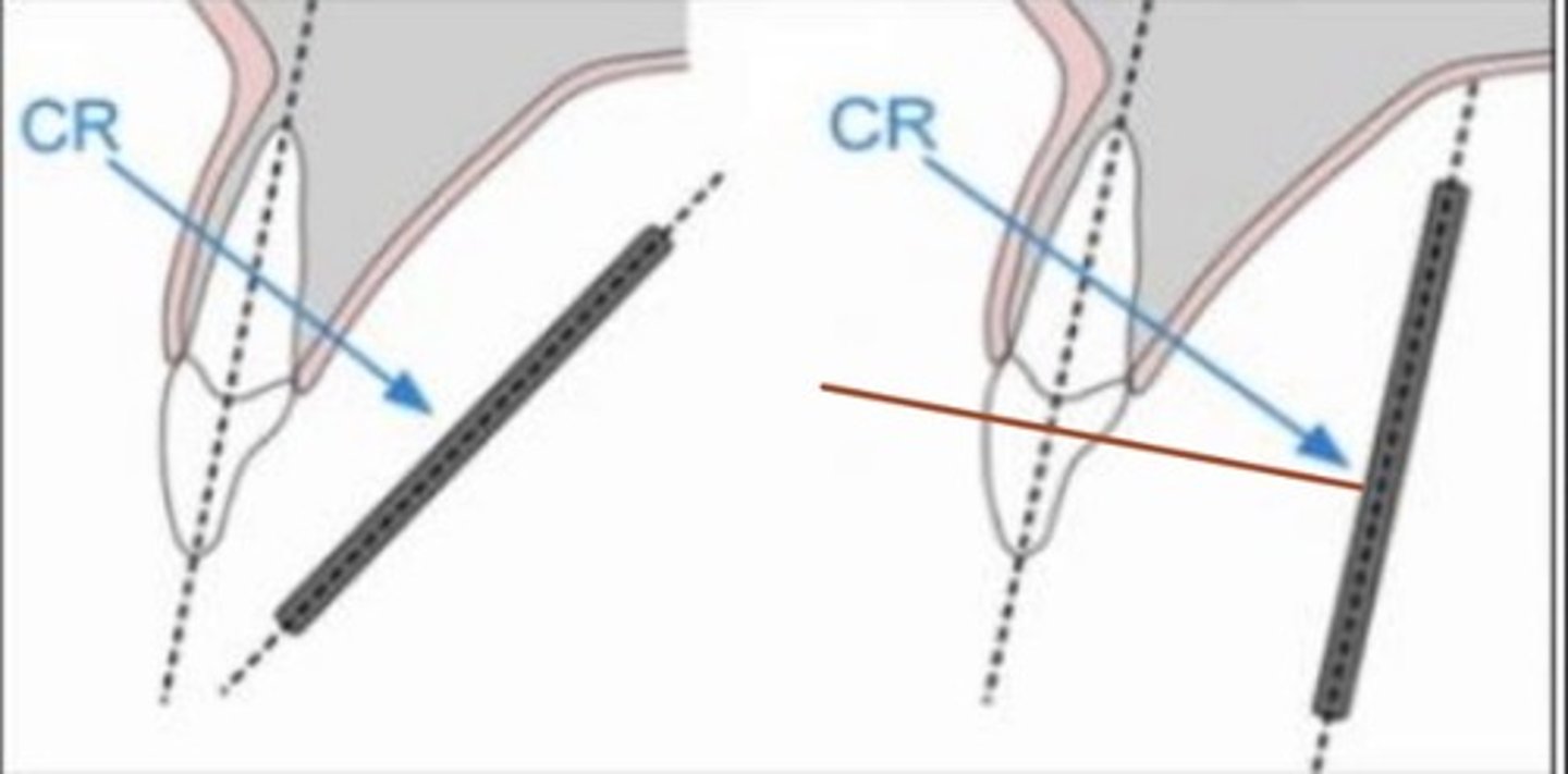 <p>increased vertical angulation</p>