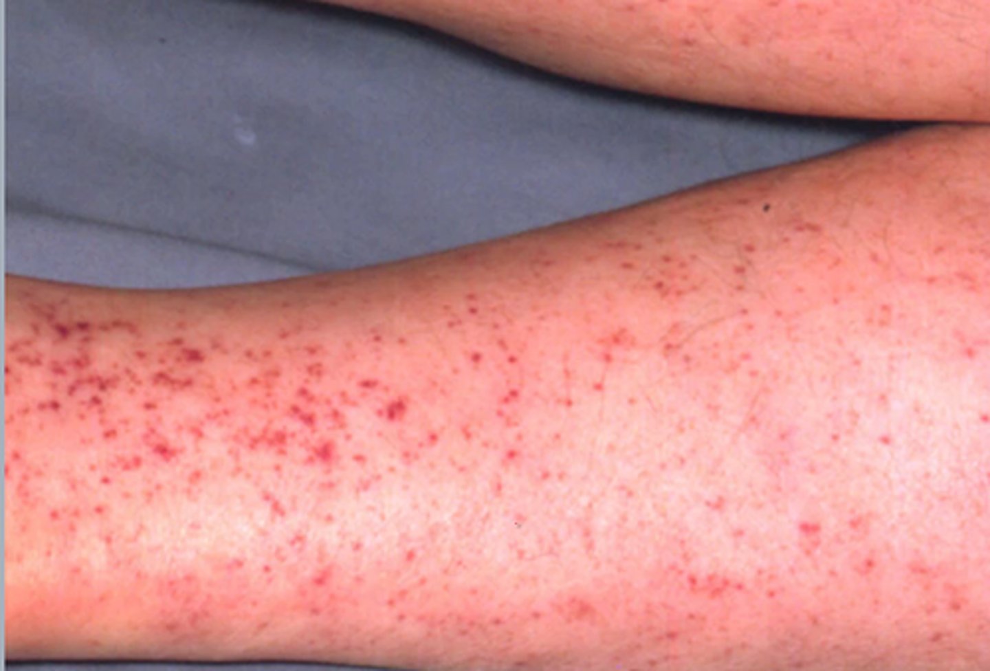 <p>tiny red or purple hemorrhagic spots caused by capillary bleeding with subsequent leakage of blood into the skin</p><p>can be the sign of something minor or major or a reaction to a medication</p>