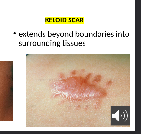 <p>extends beyond boundries into surrounding tissues</p>