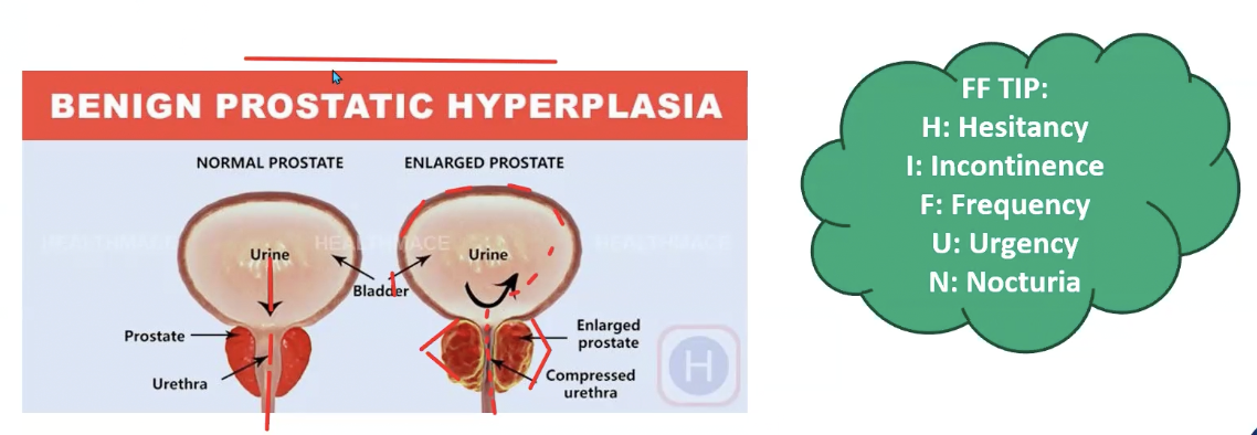 <ul><li><p>hypertrophy of the prostate glands surrounding the urethra </p></li><li><p>enlarged prostate gland causes narrowing of the urethra lumen which increases urinary retention and dilation of urinary bladder </p></li></ul><p></p>