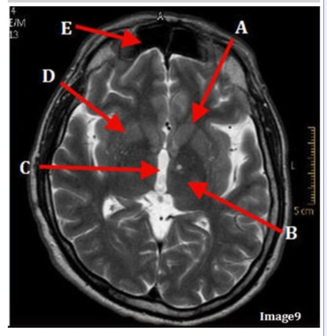 <p><span><strong>Letter C in Image 9 is pointing to:</strong></span></p><p><span> A. Third ventricle</span></p><p><span>&nbsp;B. Thalamus</span></p><p><span>&nbsp;C. Lentiform nucleus</span></p><p><span>&nbsp;D. Caudate nucleus</span></p>