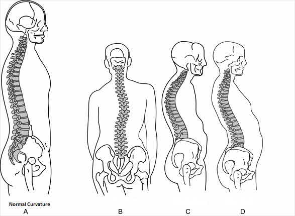 <p><span>Which of the spinal curvatures in the image below represents scoliosis?</span></p>