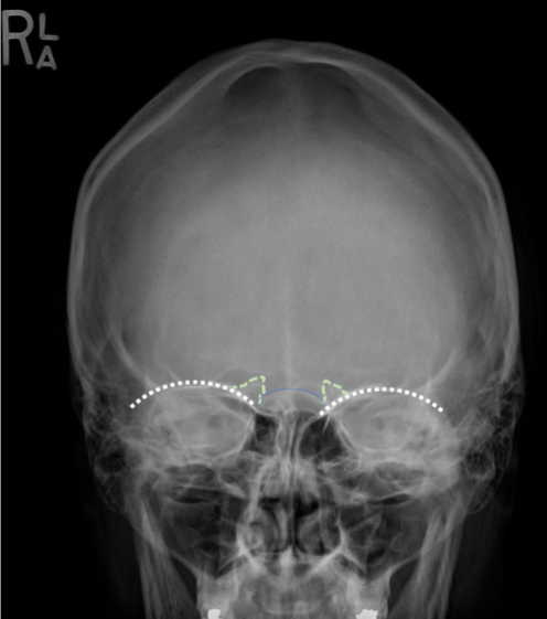 <p>F/E, OML Alignment</p><p> </p><ul><li><p>MAIN: petrous ridges are at supraorbital rim level and fill the orbits&nbsp;</p></li><li><p>anterior clinoid and dorsum sellae are superior to the ethmoid air cells</p></li></ul><p></p>