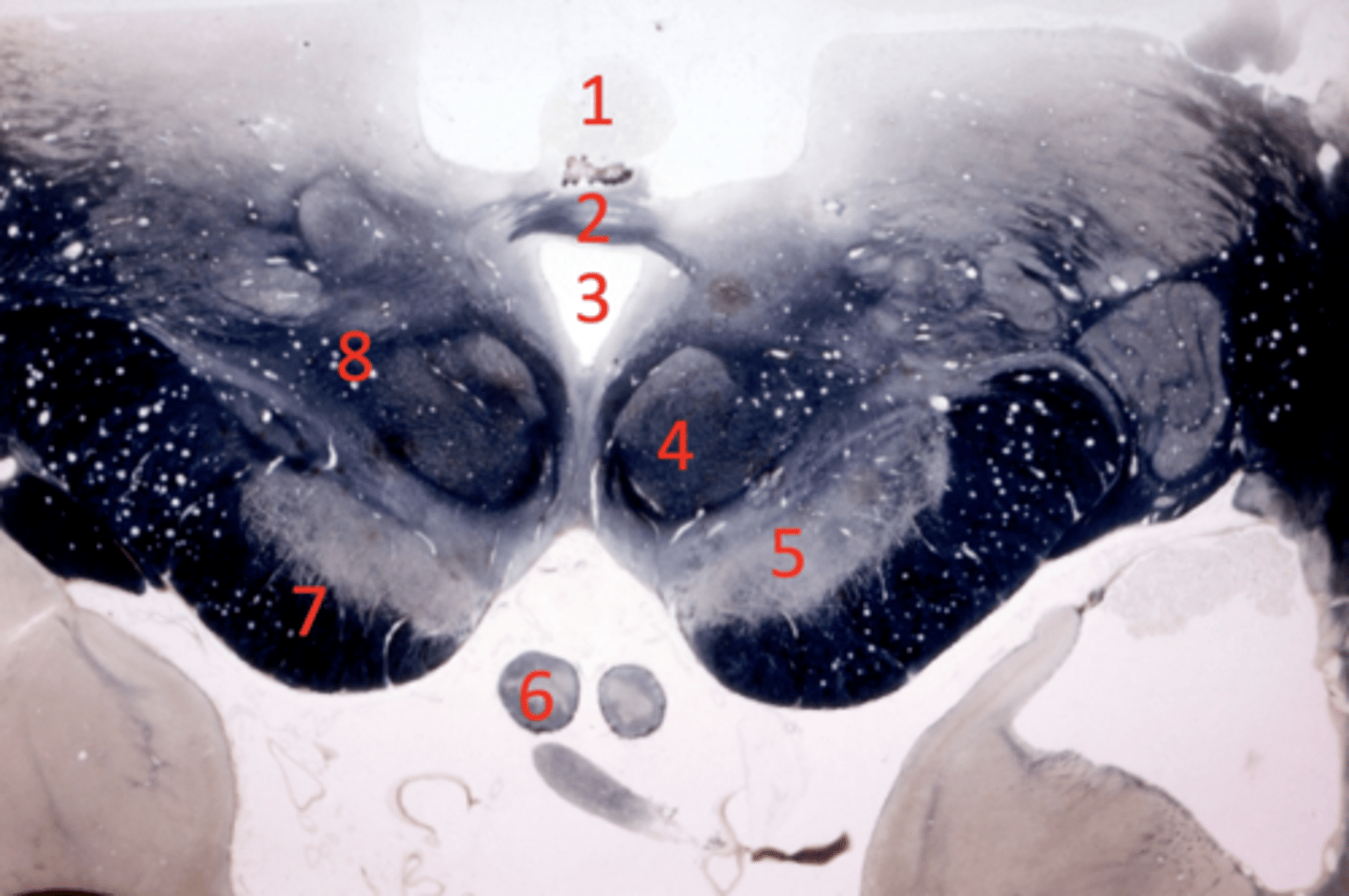 <p>posterior commissure</p>