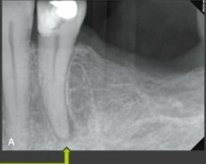 <p>what type of lesion is shown here</p>
