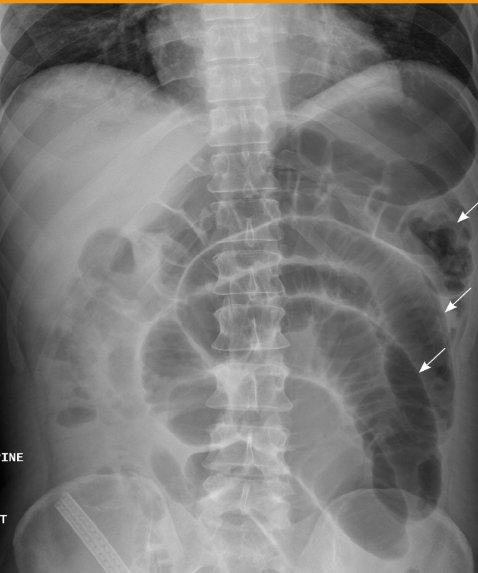 <p>What abnormality is visualized?</p><p></p>