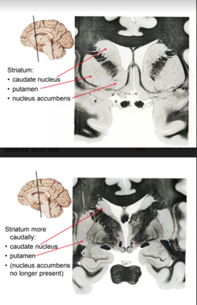<p>- Three sub-nuclei: caudate nucleus, putamen, nucleus accumbens<br>- Can be thought of as one nucleus: sometimes divided by the internal capsule, forms a single structure at the anterior-most part of the internal capsule</p>
