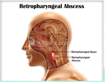 <p>abscess found in the retropharyngeal space, posterior to the pharynx and extending from the base of the skull to the mediastinum</p><p>-develops secondarily from spread of oropharynx/oral infections of pharyngeal trauma, common pathogens are streptococci and staphylococcus</p>
