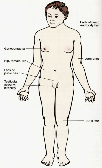 <p>Klinefelter Syndrome (XXY)</p>