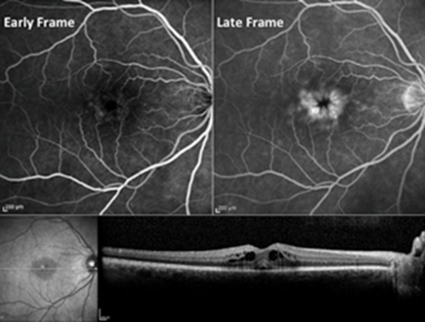 <p>in late phase, pooling hyperF fills into fluid cysts </p><p>NOTE: IVFA not typically ordered to diagnose/manage CME</p>