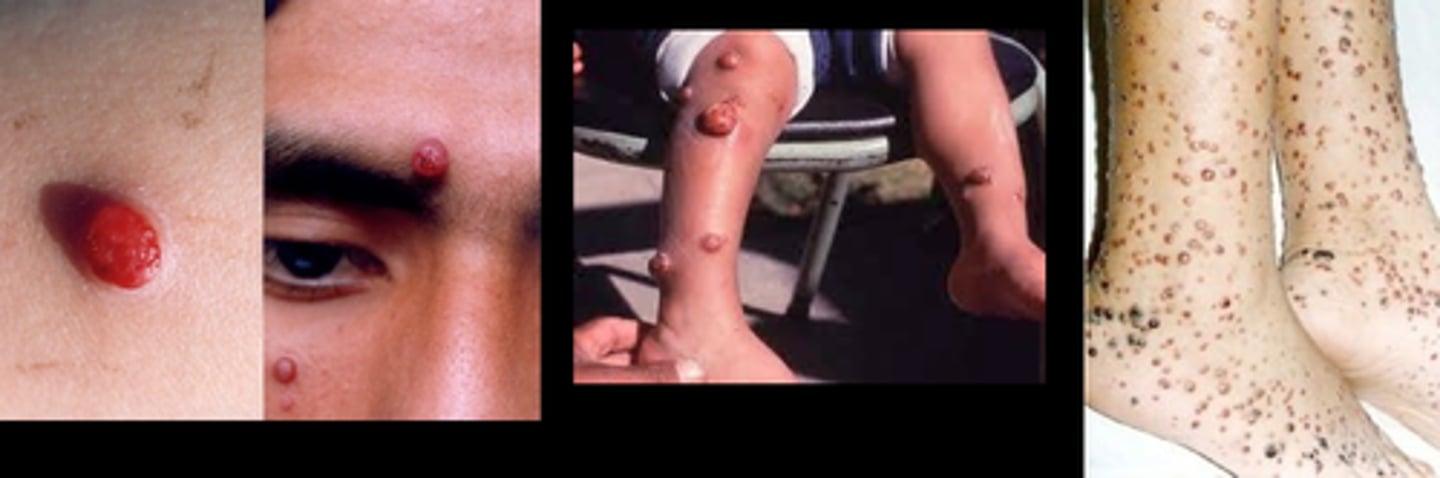 <p>-chronic form of Carrion's disease, present as skin lesion</p>