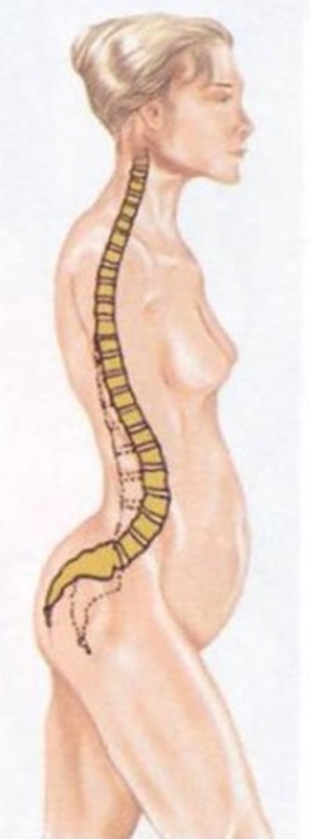 <p>an excessive lumbar curve</p>