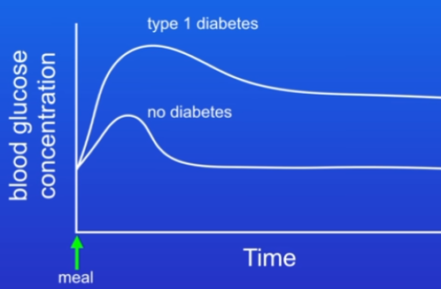 <ul><li><p>When the pancreas doesn’t produce enough insulin</p></li></ul><ul><li><p>Graph: </p><ul><li><p>2 people ate same meal w carbs - blood glucose conc rises</p></li><li><p>No diabetes - conc rapidly returns to normal levels due to insulin</p></li><li><p>Type 1 - conc rises and then stays at high level due to pancreas no producing sufficient insulin</p></li></ul></li></ul>