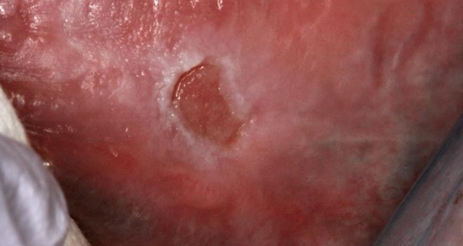<p>Ulcer from no saliva</p>