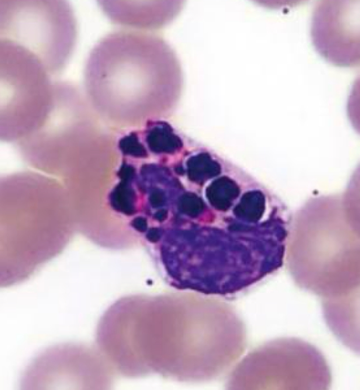 <p>Basophil, Chediak-Higashi Syndrome</p>