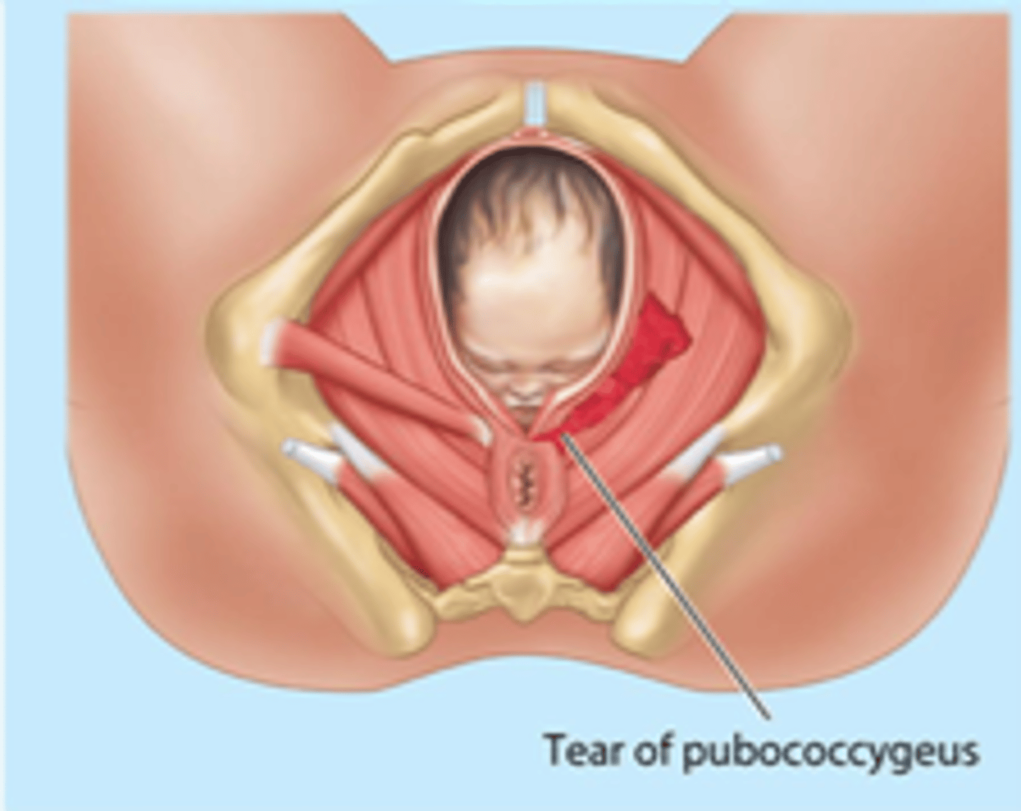 <p>-extremely common consequence of vaginal delivery</p><p>-puborectalis and pubococcygeus are most common muscles damaged, causing incontinence and sexual dysfunction</p>