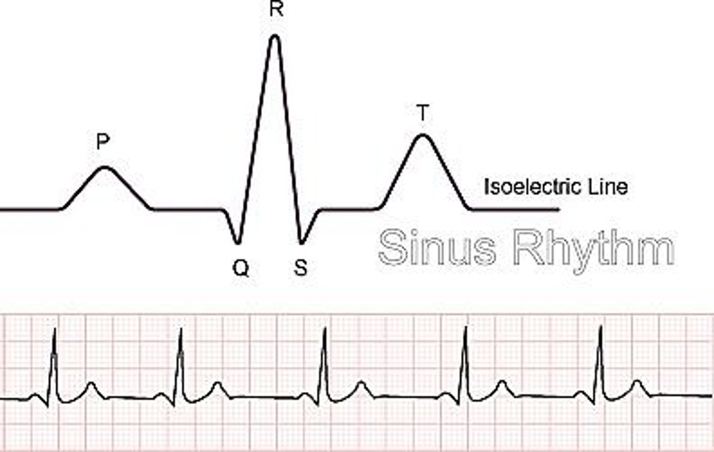 <p>Atrial depolarization.</p>