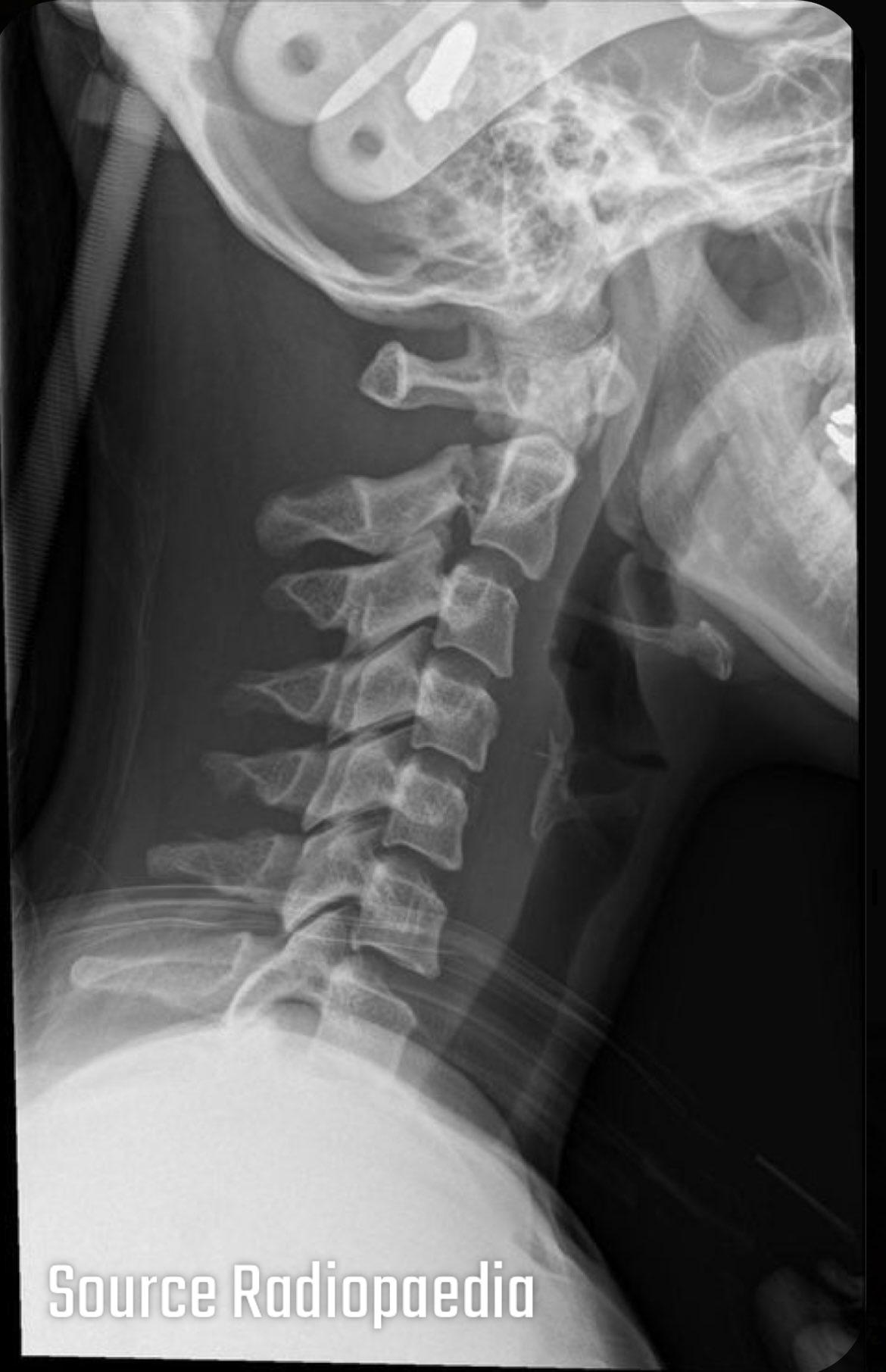 <p>What type of fracture is shown?</p>