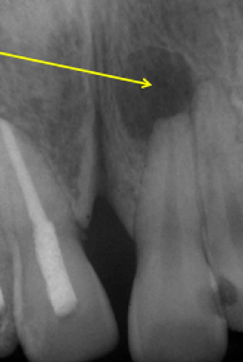 <p>radiolucent lesion</p><p>LOSS of lamina dura</p><p>margins either ill/well defined</p><p>corticated/non corticated</p>