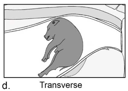 <p>When the body of the fetus is flexed at the backbone or side, becoming lodged in the birth canal</p>