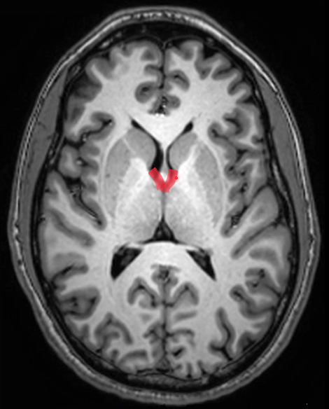 <p>connects each lateral ventricle to 3rd ventricle</p><p>contains choroid plexus</p>